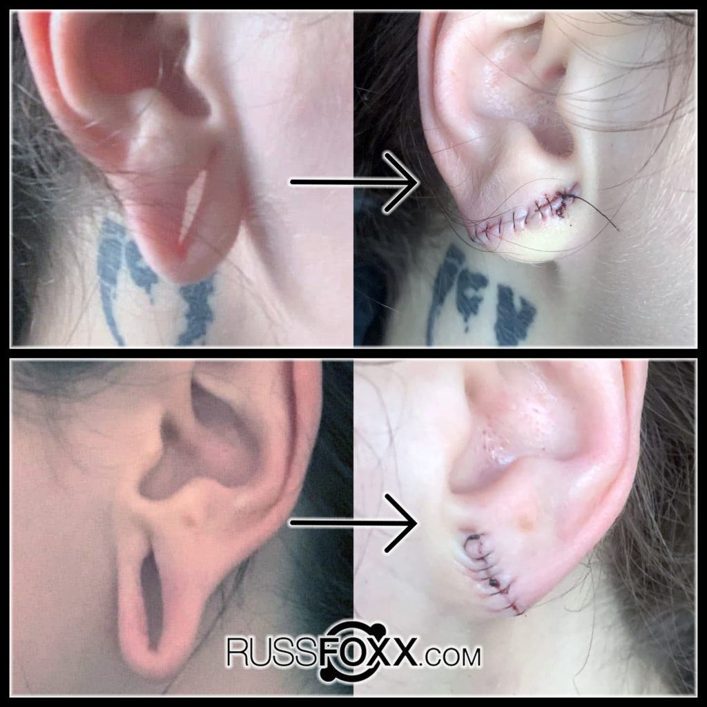 Quinn's earlobe reconstructions